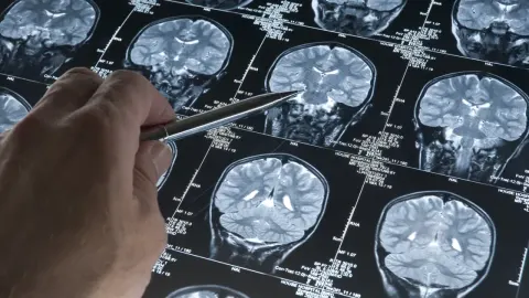 Alzheimer'da gençlik proteini keşfi